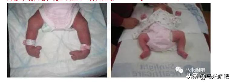 ponseti治疗足内翻要多少钱,ponseti治疗儿童马蹄内翻成功率
