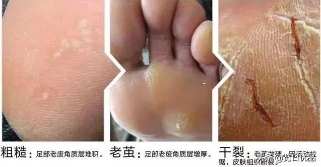 爽炸了!干丑裂的脚皮,一张完整撕掉,敢跟婴儿比姣嫩!