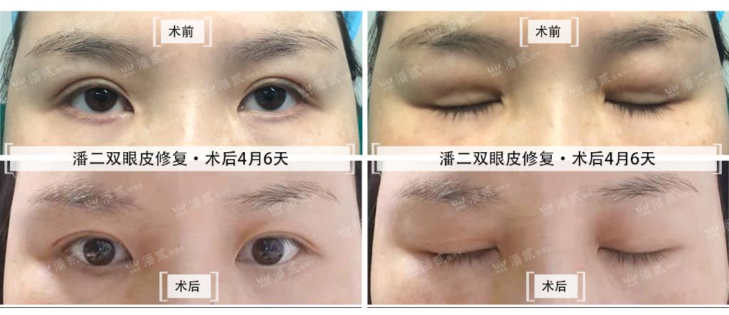 做过韩式三点双眼皮还能重新做吗,韩式三点双眼皮5年后修复