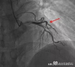 心电图危险指数两颗星,高危心电图的识别