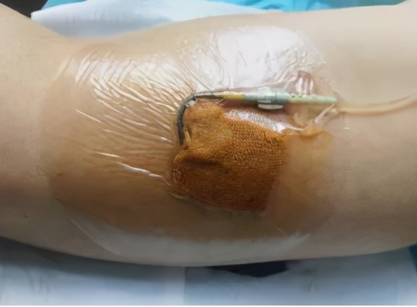 碘伏治疗PICC导管穿刺点感染的体会