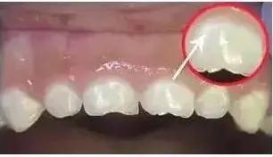 牙齿上有白斑是缺氟还是氟多了,儿童新长的牙有白斑黄斑会烂掉吗