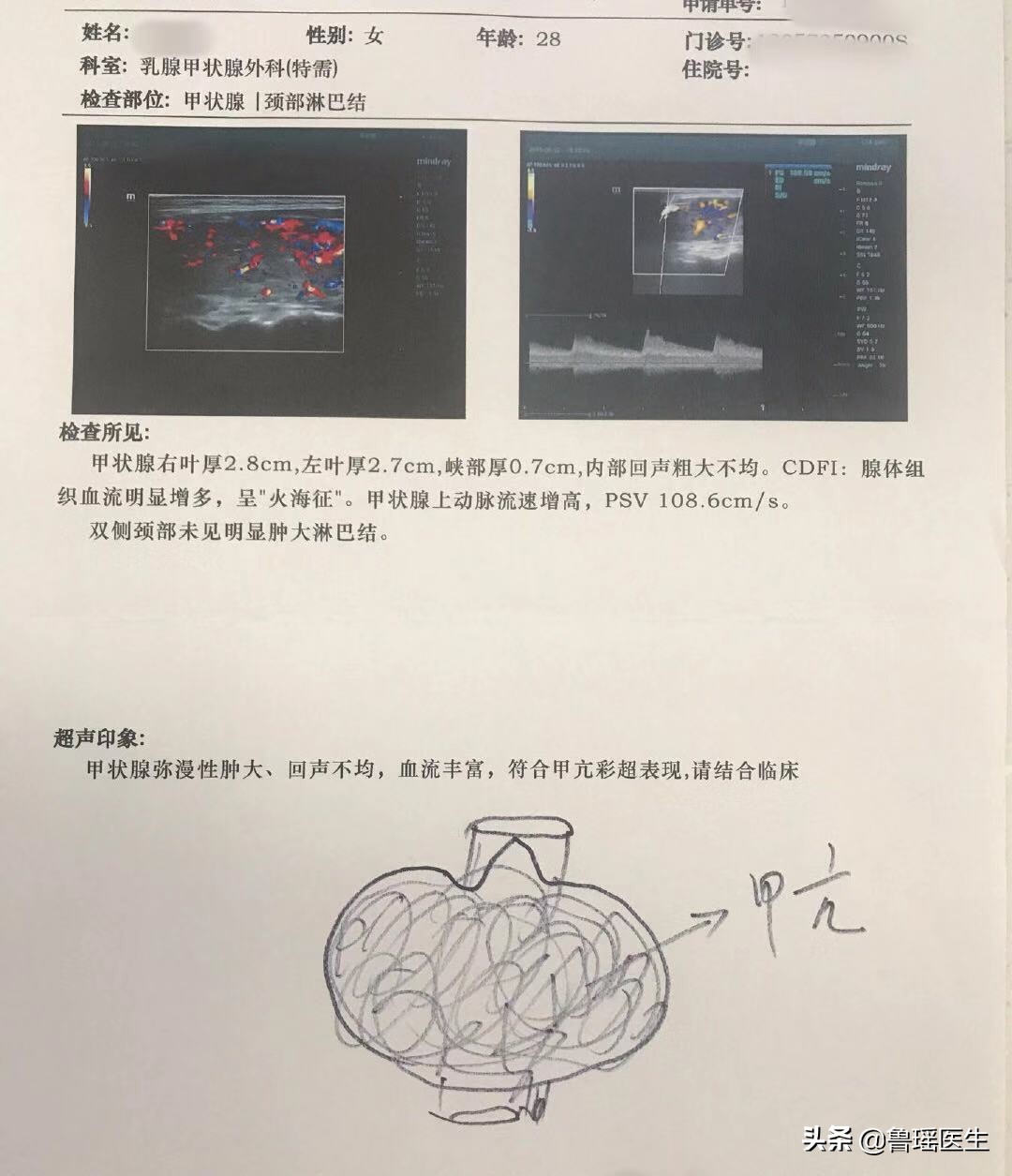 甲亢七年可以做消融吗,甲亢七年