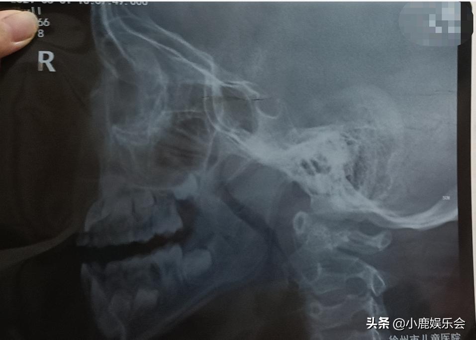 儿童扁桃体手术20天能正常吃饭吗,扁桃体腺样体手术7-15天亲身感受