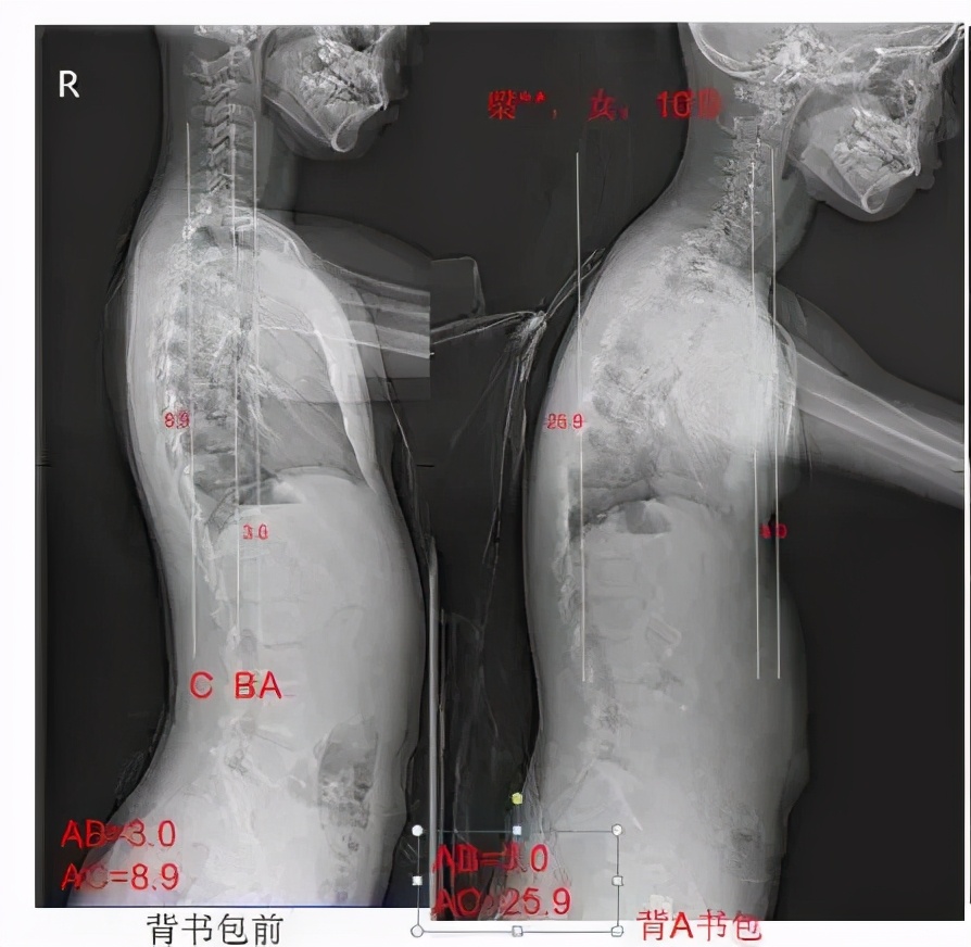 1.5米的孩子适合背多大的书包,小学生书包多重合适