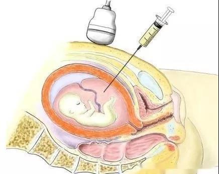唐筛低风险需要给医生看吗,唐筛高危告诉你唐筛结果怎么看