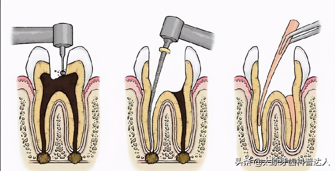 根管治疗为什么分几次,牙齿做根管治疗5次了还疼