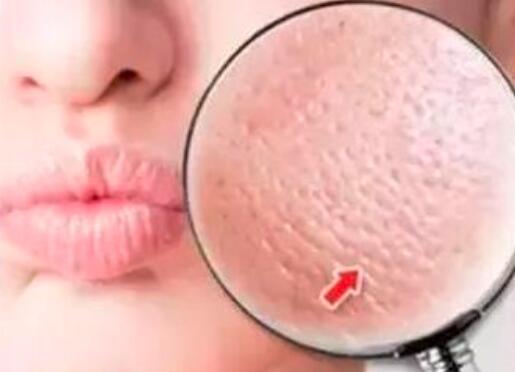 疏通毛孔堵塞闭合性粉刺视频,油性皮肤毛孔堵塞粉刺怎么改善