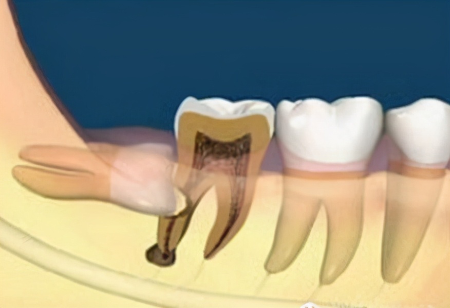 智齿到底要不要拔掉专家告诉你,有什么办法治疗智齿