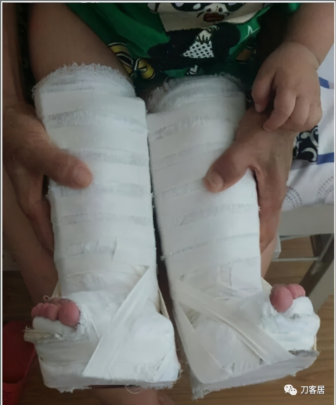 一个脊柱外科医生与马蹄内翻足的纠缠-写在6.3国际马蹄内翻足日前