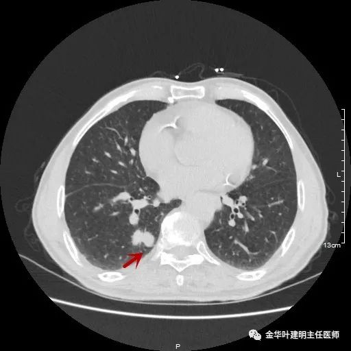 多发原发肺癌能根治吗,肺部原发性恶性肿瘤好治