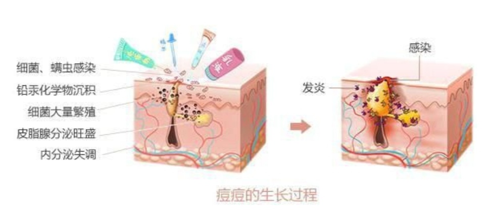 去角质的正确使用方法和步骤,角质层薄用什么去角质比较好