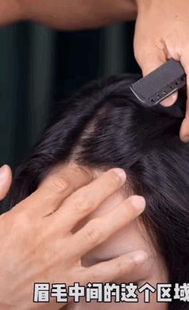 颅顶高了但发际线高怎么办,颅顶低的几种补救办法