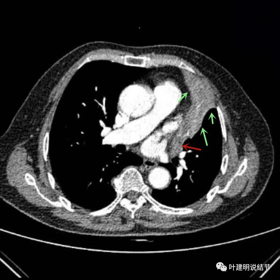 高龄肺癌靶向治疗效果,高龄老人肺癌早期适合放疗吗