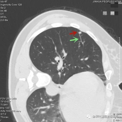叶建明谈胸膜下的实性结节,叶建明肺实性良性结节会变癌症吗