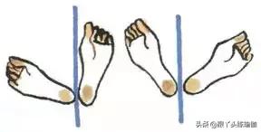 骨盆前倾和后倾的自我康复视频,骨盆前倾后倾评估和改善