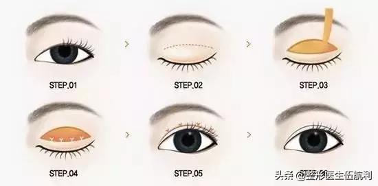 眼睛小应该做哪些眼综合手术,眼睛不对称怎么矫正医美