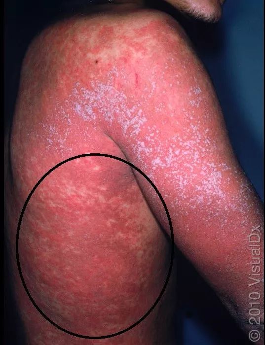 发热出红疹子可以吃过敏药吗,发热皮疹会反复么