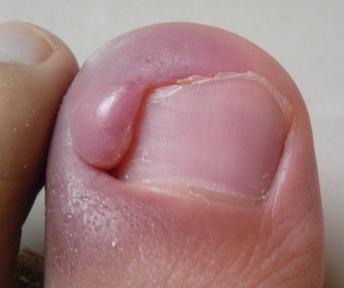 大脚趾头甲沟炎嵌甲钻心的痛,急性手指甲沟炎钻心疼痛