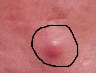 怎么祛痘印最快最有效的方法,如何快速祛痘印最有效的方法