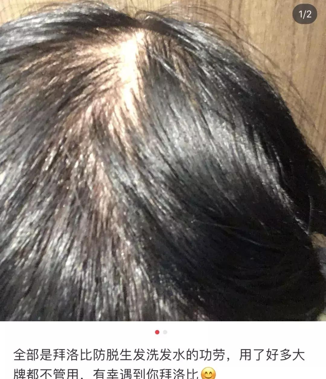 头发毛躁并且脱发推荐洗发水,用什么洗发水改善头皮脱发