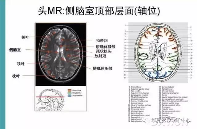 电子版头颅ct与mri断层解剖,头颅mri血管解剖与分段详解