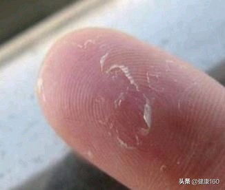 手脱皮考虑什么诊断,手脱皮有哪几种类型