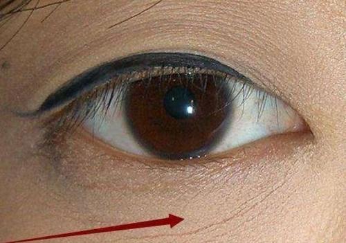 眼部最近出现了细纹怎么办,眼部细纹突然多