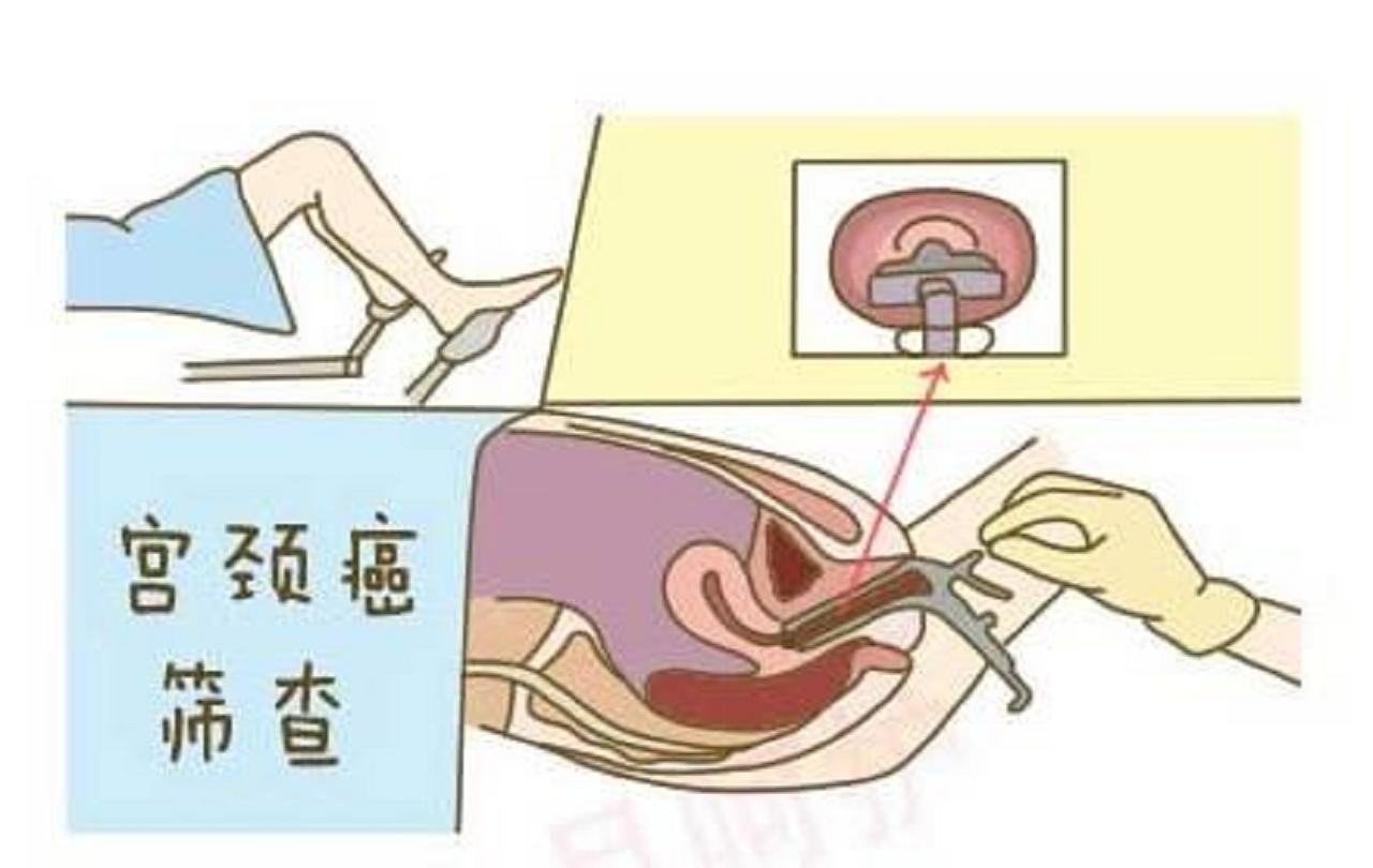 hpv和tct哪个是确诊宫颈癌的,每年都做hpv和tct能预防宫颈癌吗