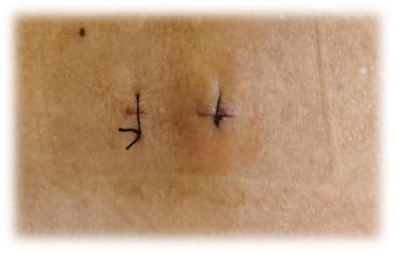 脊柱外科微创融合,脊柱外科微创手术成功案例