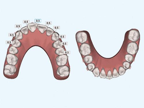 成年人做牙齿矫正合适吗,成年人有必要做牙齿矫正吗