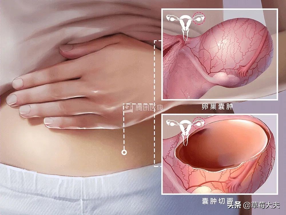 女娃腹痛,卵巢囊肿腹痛要做手术么