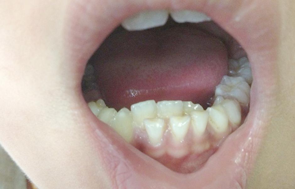 宝宝换牙旧牙怎样处理,宝宝出的新牙不整齐怎么办