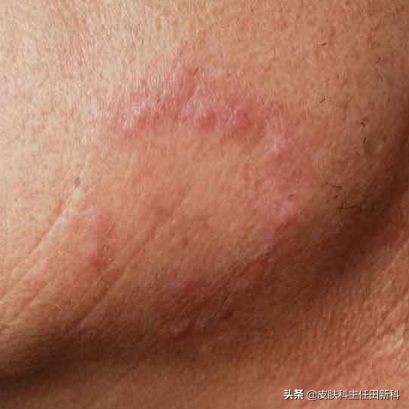 脸上痘印变成癣了怎么回事,痘印长癣