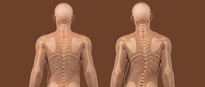 成人s型脊柱侧弯40度怎么治疗,成人矫正脊柱侧弯的护具有效果么