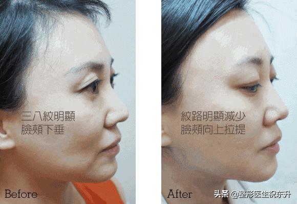 做脸部线雕的材料有区别吗,线雕面部提升什么线材好