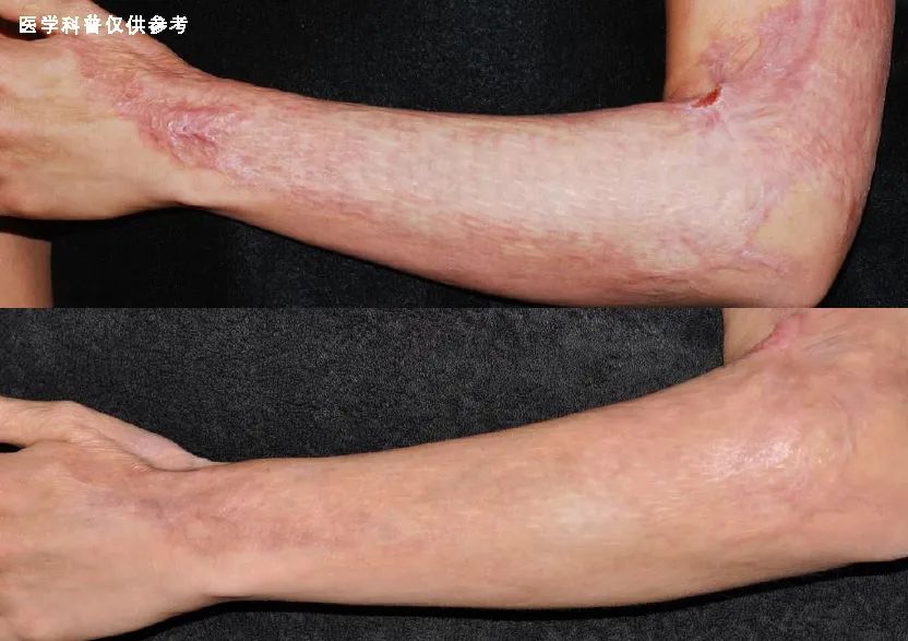 被火烫伤疤痕修复最好的方法,烧烫伤疤痕治疗的方法都有哪些