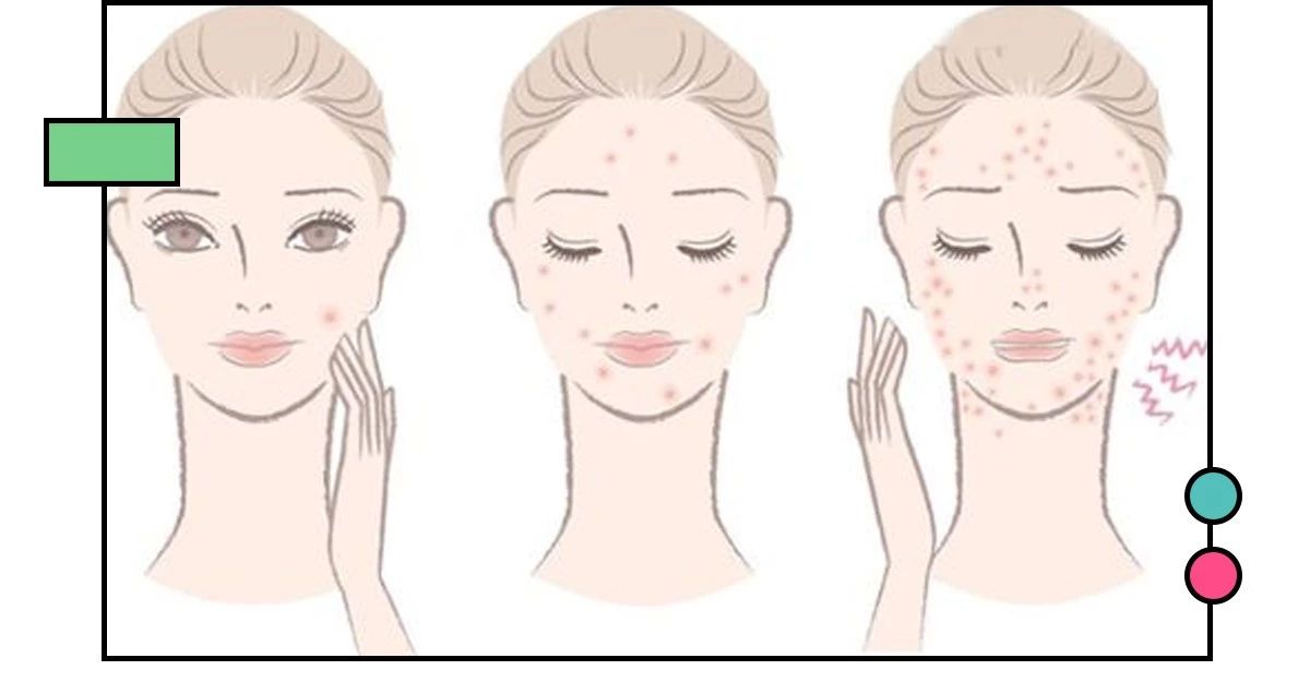 如何祛痘印？看了这篇能解决你大部分的问题！