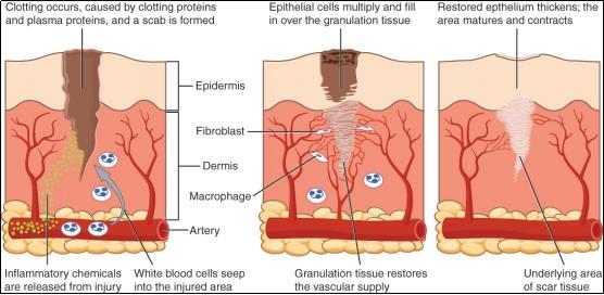 肥胖纹很严重怎么消除,有效去除肥胖纹的方法