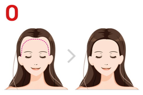 刘海可以盖住发际线的发型,适合发际线高并且没有刘海的发型