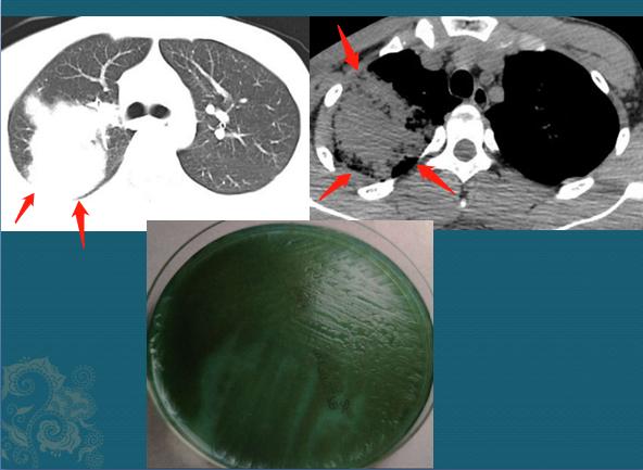 这种感染比冠状病毒更危险，还好不传染，白细胞能压制它