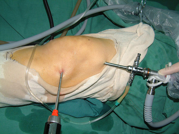 膝关节术后3个月弯曲不过100度,膝关节术后8个月一直不消肿