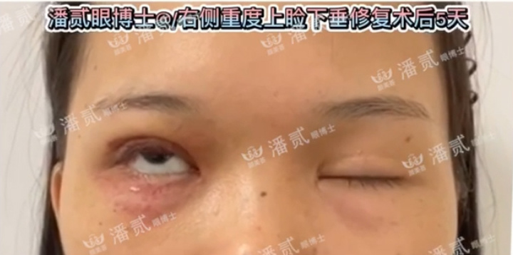 上睑下垂手术是不是永远闭不上眼,做了上睑下垂手术后怎么护理眼睛