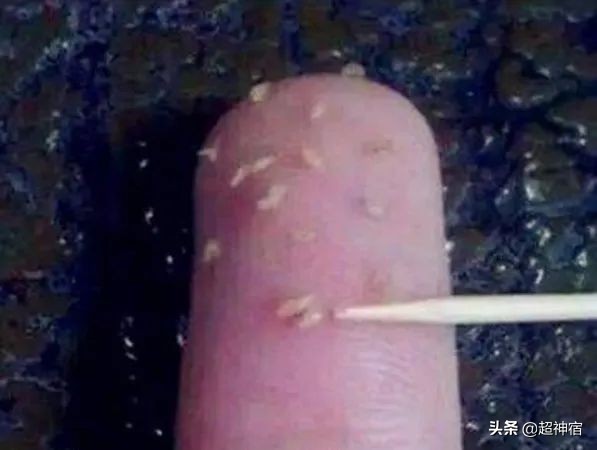 比痘痘更烦人的闭口来了，最有效的去闭口*法大**看过来