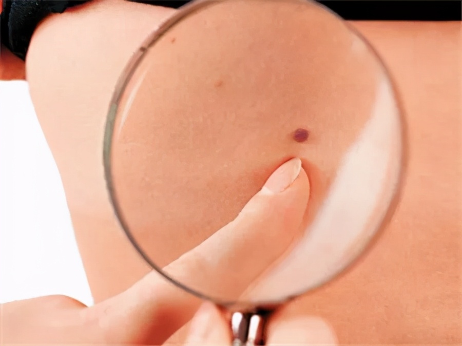 身上长了小黑点是不是癌症,头上有个黑痣是黑色素瘤吗