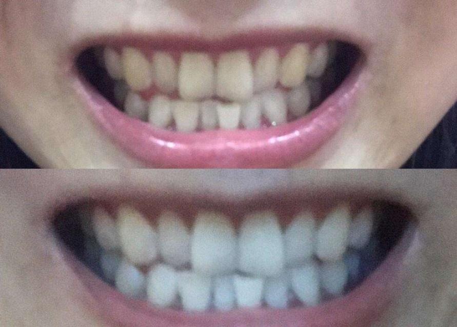 牙黄口臭怎么办用什么牙膏,黄牙口臭解决方法牙膏