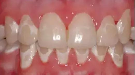牙齿为什么有白斑点,牙齿脱矿白斑用涂氟剂可以修复吗
