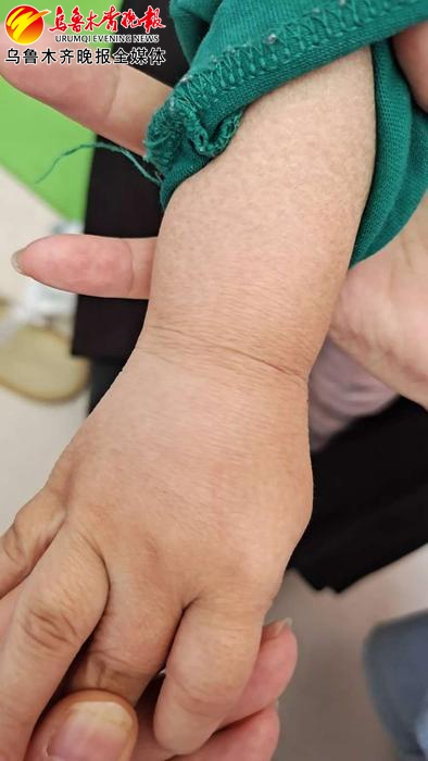 小孩子身上长蛇皮癣,两岁男孩身上长癣