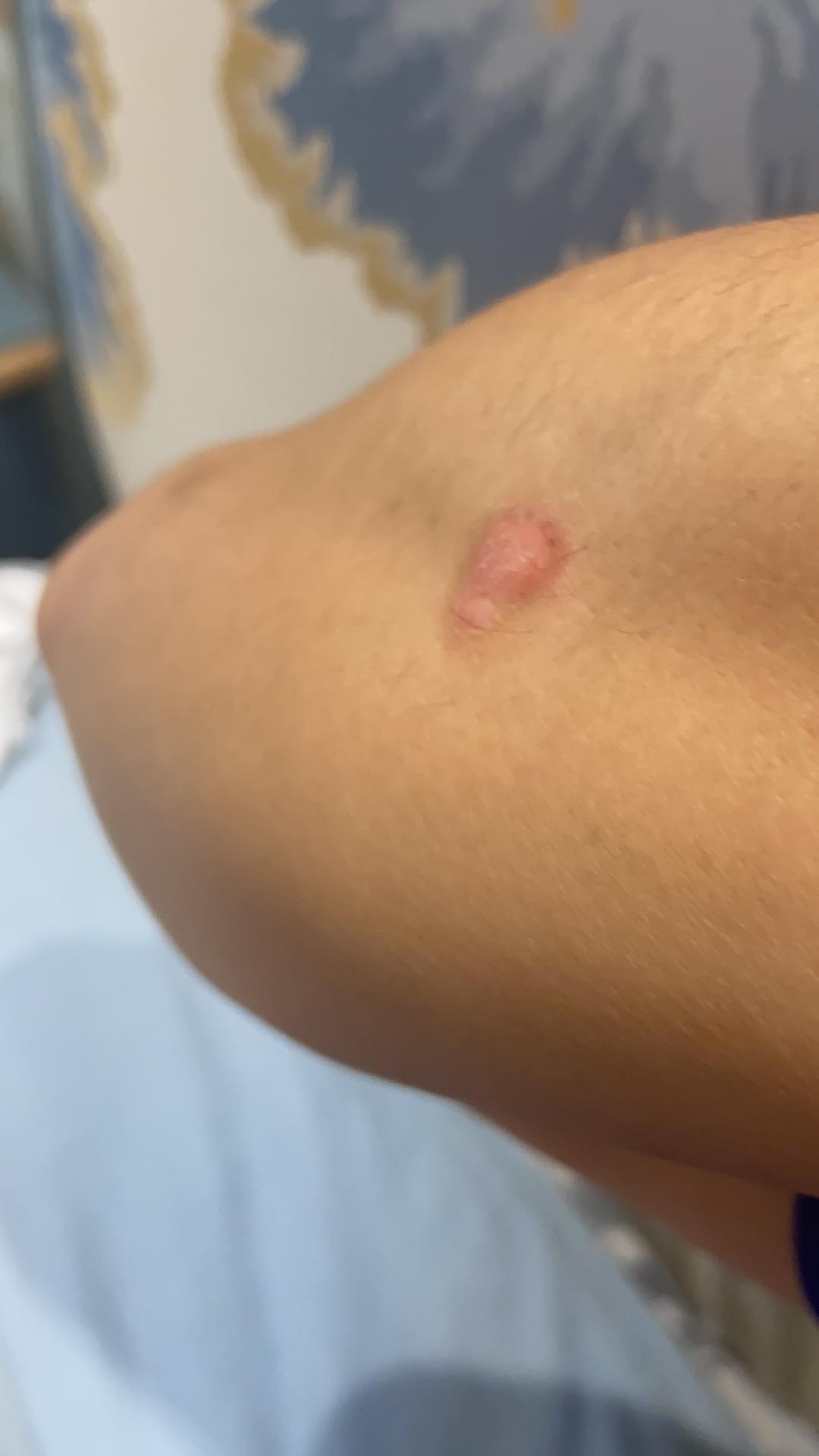 关于银屑病患者在冬季的注意事项,银屑病打生物制剂以后饮食要注意