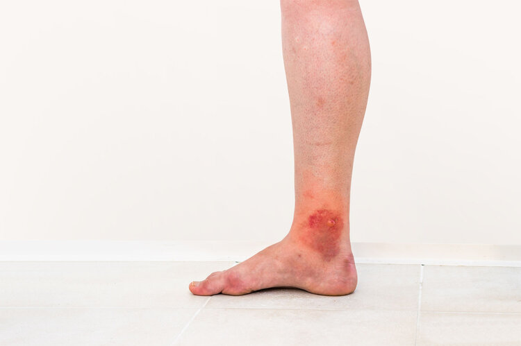 脸部感染溃烂后留疤,面部溃烂已穿孔